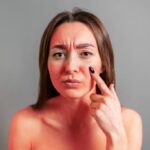 क्या आप भी हैं सनबर्न से परेशान? तो अपनाएं ये घरेलू नुस्खे, मिलेगी राहत