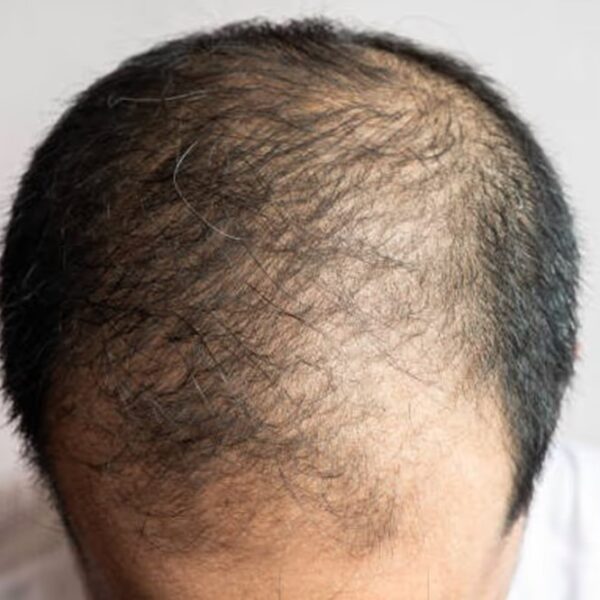 क्या सच में हेलमेट पहनने से झड़ते हैं बाल? जानिए हकीकत