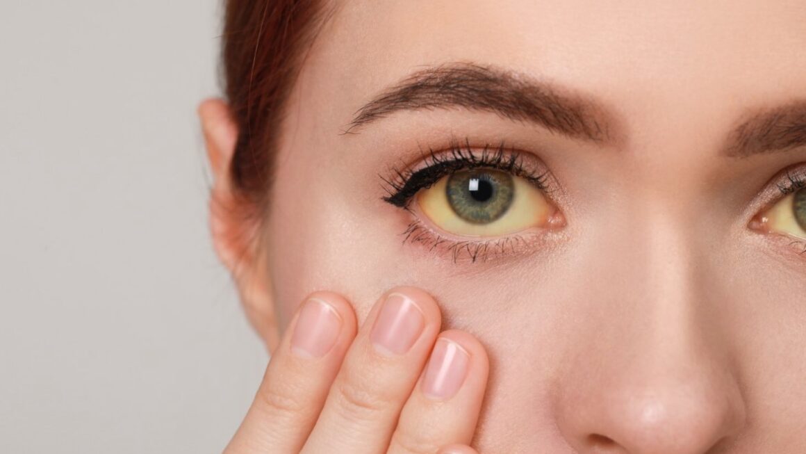 क्या है पीलिया, और यह कैसे विकसित होता है? आइये जानते हैं इसके लक्षण और कारण