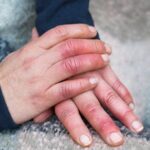 सर्दियों में क्यों होती है हाथ-पैर पर सूजन और जलन की समस्या? आइये जानते हैं इसके कारण