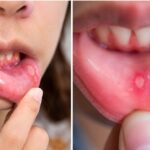 मुंह के छालों से हैं परेशान? अपनाएं ये आसान घरेलू उपाय, मिलेगी राहत